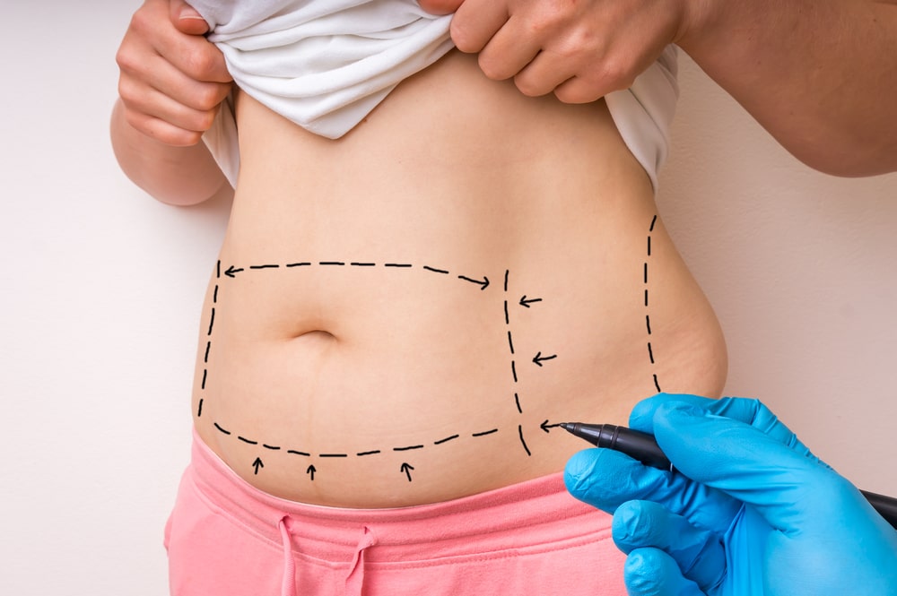 Tummy Tuck Surgery